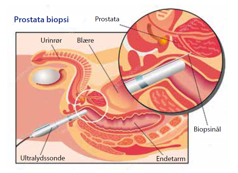 Prostata biopsi